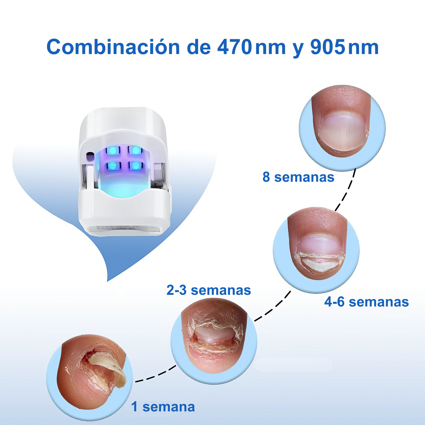 Dispositivo Láser Antihongos – Tratamiento Seguro desde Casa