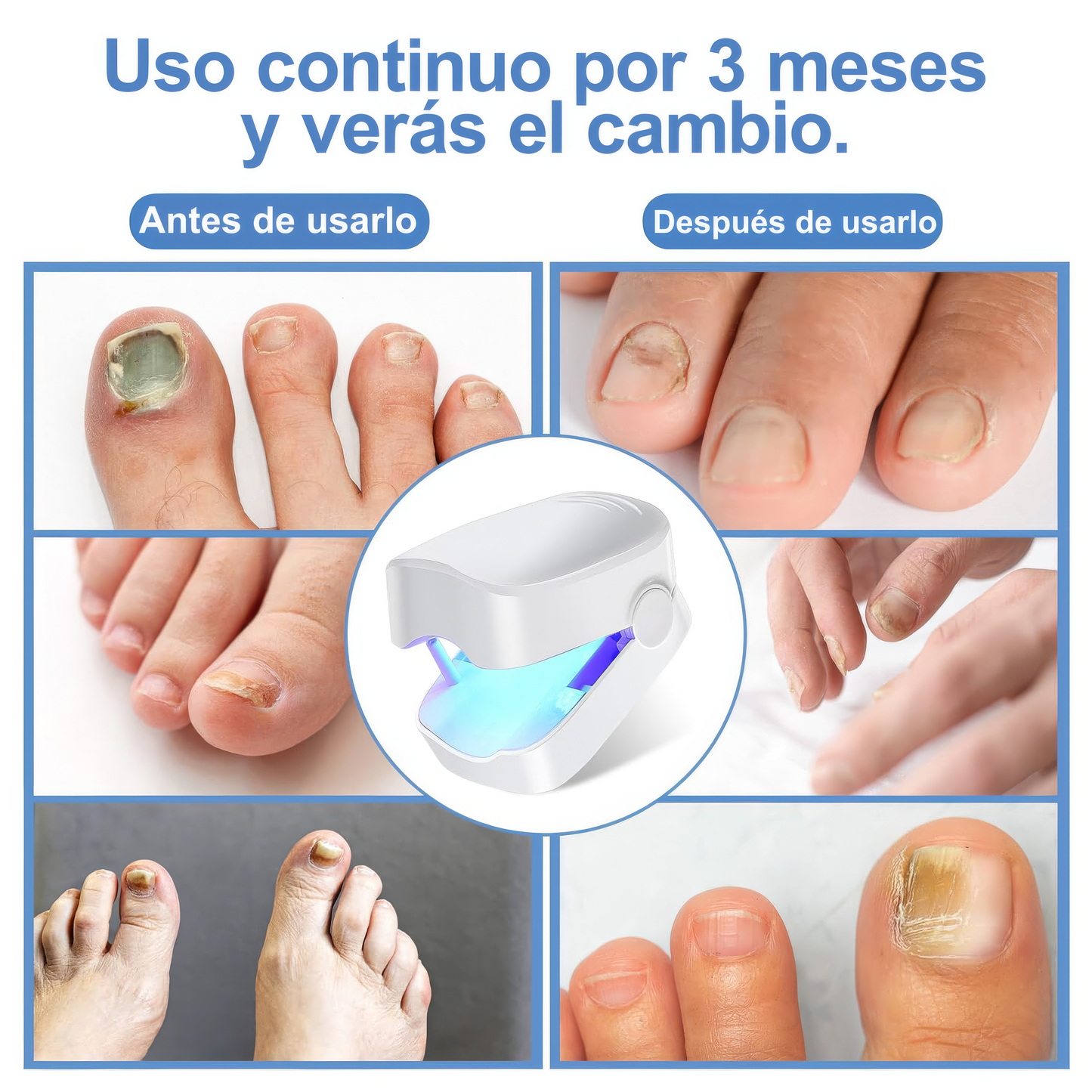 Dispositivo Láser Antihongos – Tratamiento Seguro desde Casa